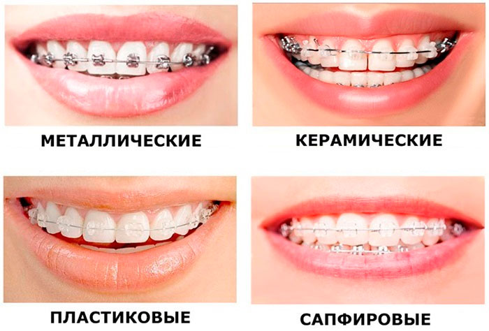 Стоимость исправления прикуса Стоимость исправления прикуса