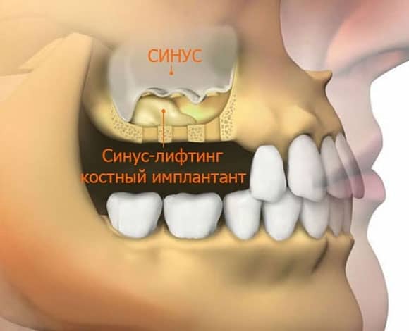 Два типа синуслифтинга Два типа синуслифтинга