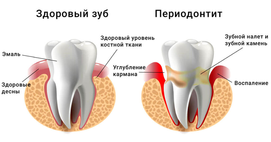Лечение периодонтита Лечение периодонтита