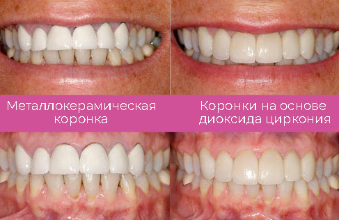 Заметны ли коронки? Заметны ли коронки?