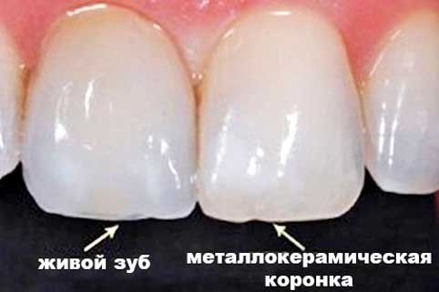 Коронка из металлокерамики Коронка из металлокерамики