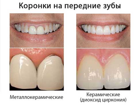 Преимущества коронок Преимущества коронок
